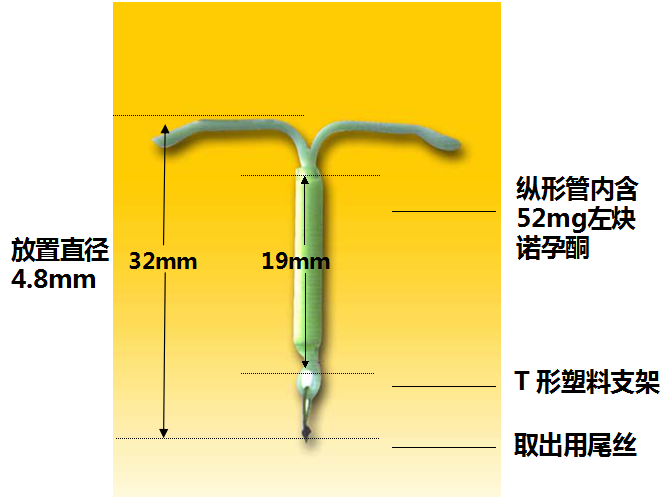 曼月乐环我是一只避孕环还可治疗多种妇科病