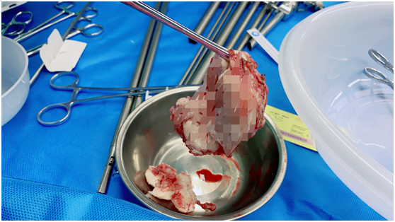 微创妇科|我院妇科成功实施一例腹腔镜下7厘米左右子宫肌瘤剥除术