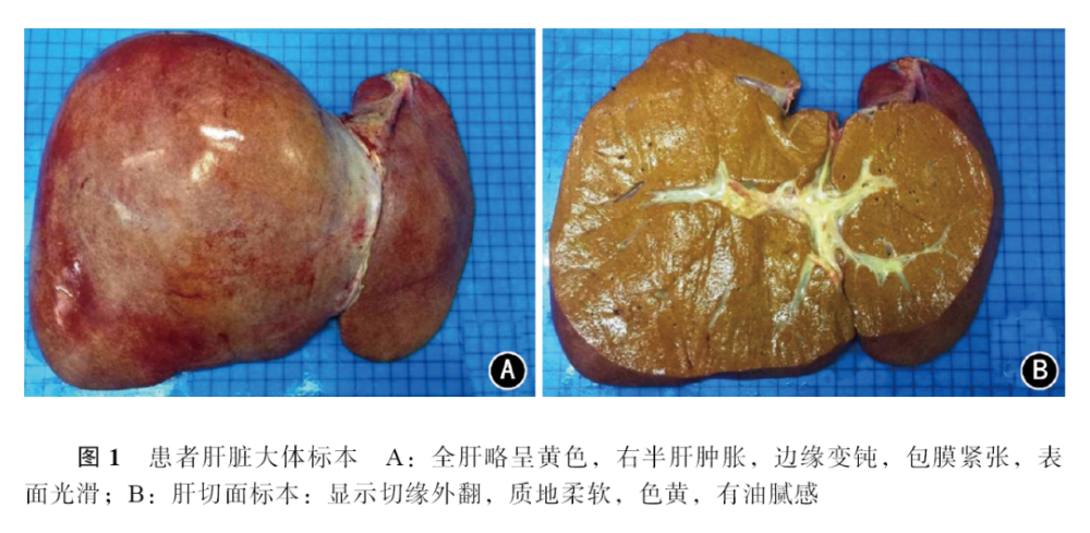 手术顺利,术后病肝病理回报:肝细胞弥漫小泡性脂肪变性及灶性水样变性