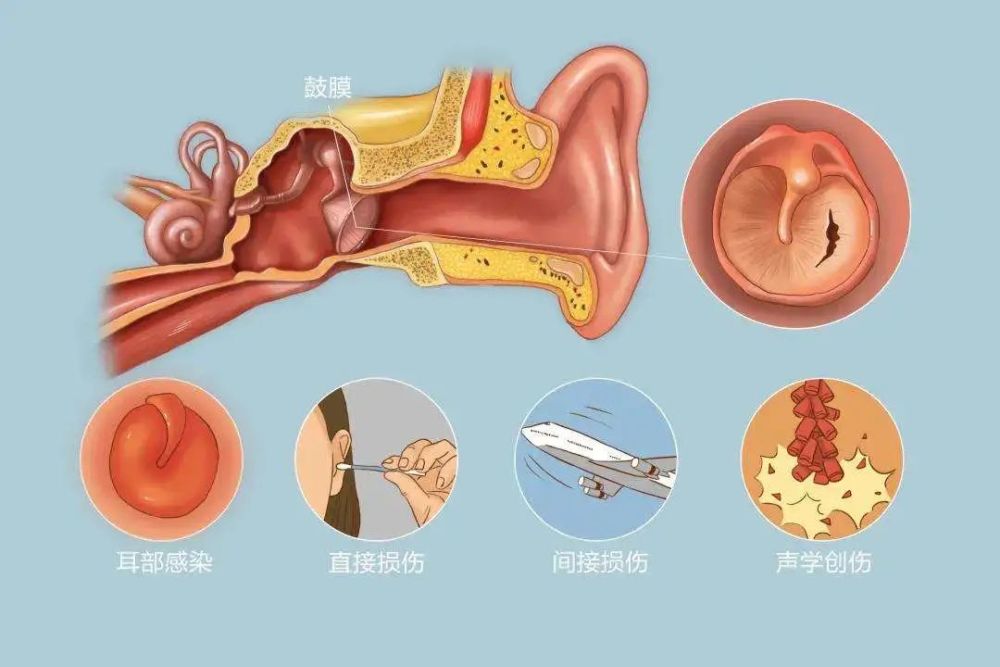 鼓膜穿孔了怎么办必须要立刻补吗