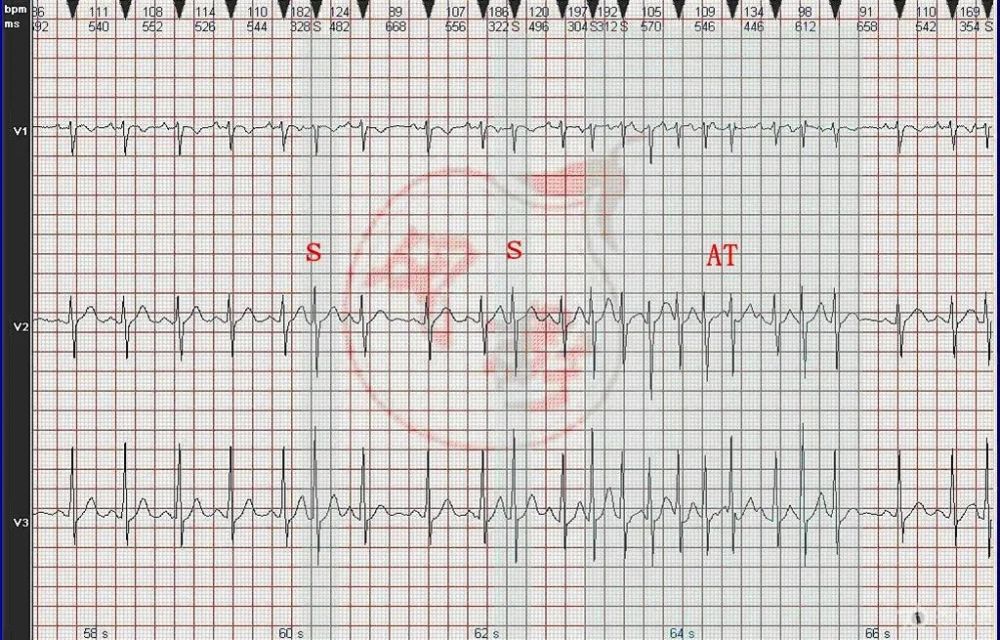 心电图图例分析19窦性心动过速房性心动过速伴不规则传出阻滞