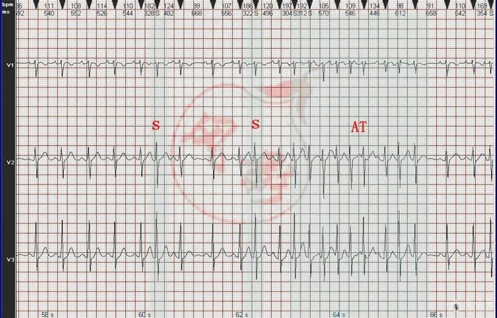 心电图图例分析19:窦性心动过速,房性心动过速伴不规则传出阻滞
