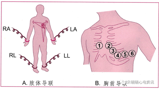 某些进口心电图机的导联线插件上注有ra 右上肢,la 左上肢,ll