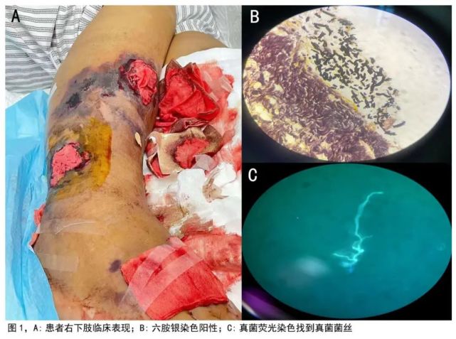 下肢伤口组织病理送检考虑为炎性肉芽组织,组织表面炎性渗出物内可见