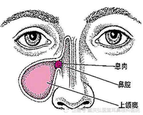 重庆弘医堂医院讲解:鼻息肉有哪些常见的症状表现