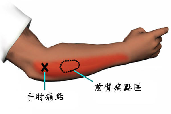 网球肘如何治疗最好的方法|伸肌|网球肘|疼痛