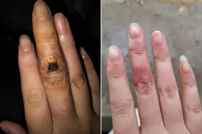 19岁姑娘手指红肿溃烂,20多天没愈合,只因被虾扎了一下