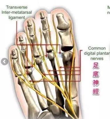 容易被误认的前脚掌痛