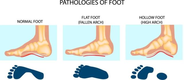 8个缓解高足弓疼痛的练习