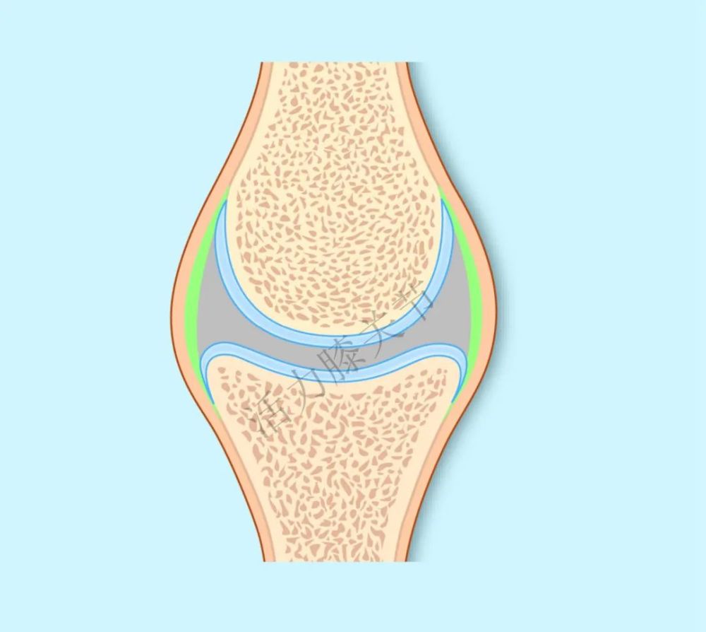 在健康关节中,一层光滑的软骨层(蓝色所示)保护着骨骼