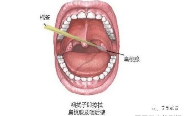 缓慢将拭子头伸入口腔,越过舌根,在咽后壁上下擦拭扁桃体隐窝或腭弓