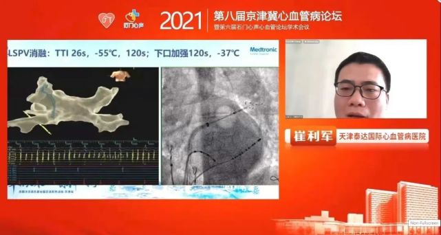 崔利军教授《冷冻消融病例分享 》电生理专场首都医科大学附属北京