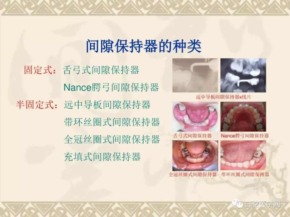 间隙保持器的种类,适应证及制作