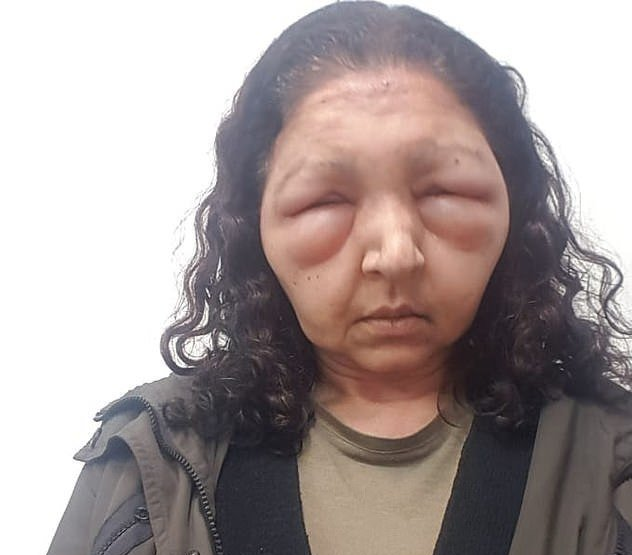 颜面浮肿当一个人的心脏或血液出现病症后,身体的外