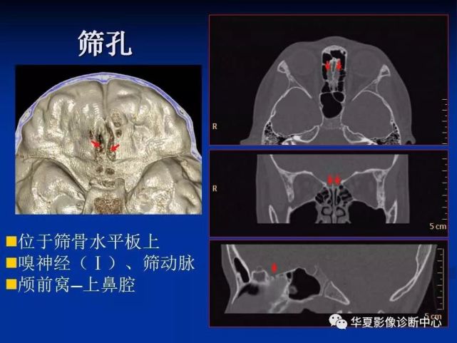 实用,详细的颅底各孔道影像解剖!