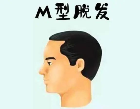 对照脱发1-7级程度图片,看m型脱发是什么原因引起的?