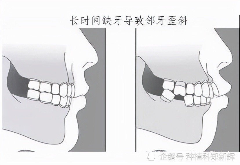 牙槽骨吸收了,想种牙都难