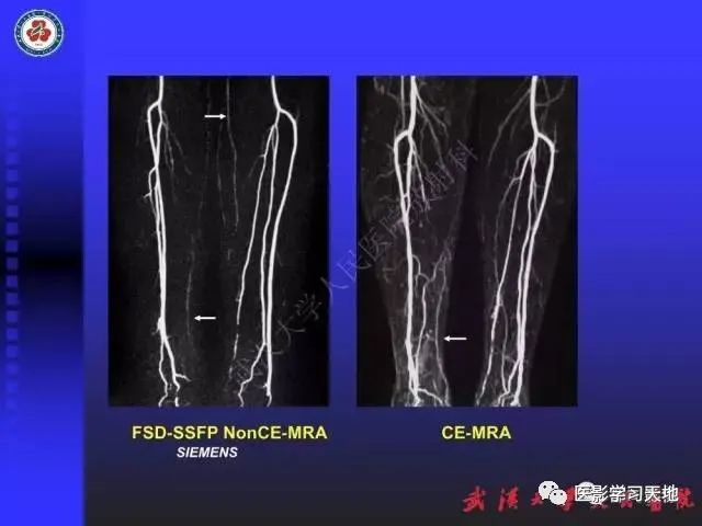 下肢血管性病变cta和mra