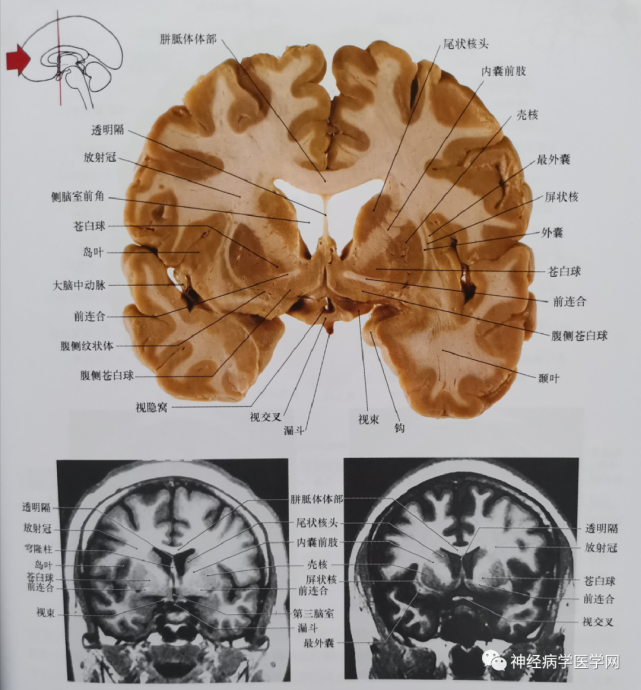 临床神经解剖图谱(断层影像 切片|尾状核|侧脑室|临床|切片