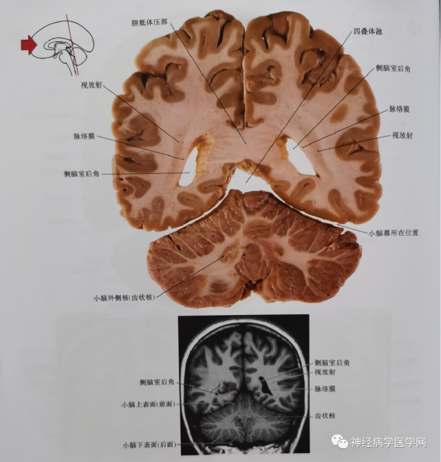 此平面亦通过侧脑室三角区.