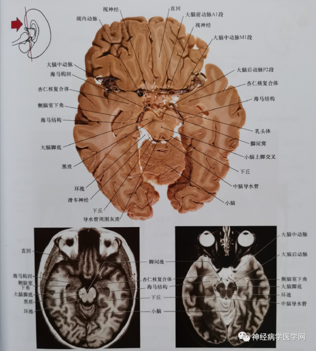 交叉,亦可见滑车神经在环池内走行,还可以看到乳头体与脚间池的关系