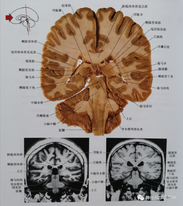 图6 通过丘脑枕核,内外侧膝状体核,中脑和脑桥被盖及延髓腹侧平面的