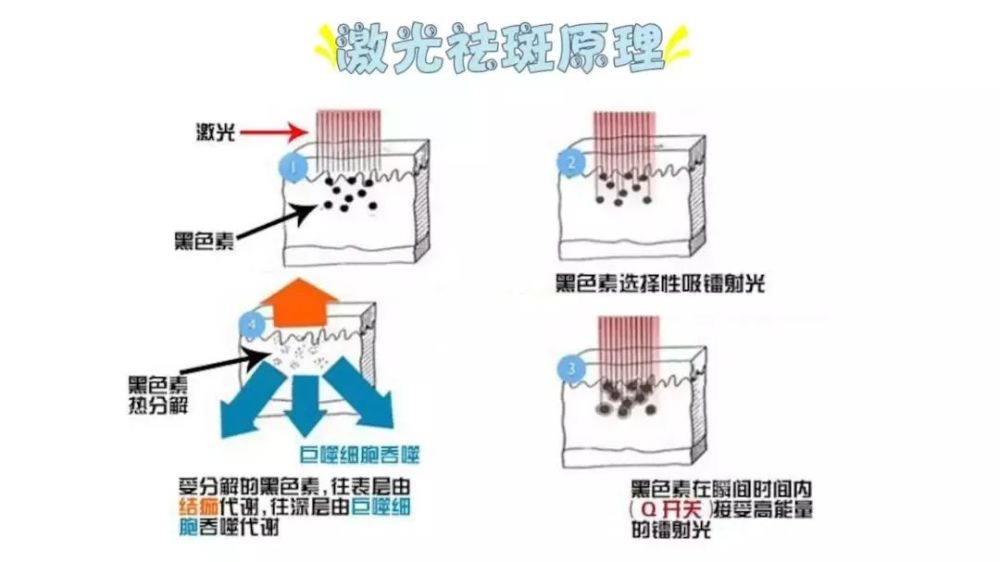 光子嫩肤射频激光更适合你