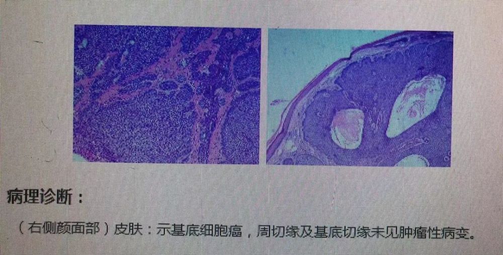 几天后,病理报告提示肿物符合基底细胞癌的改变,边缘和基底未见瘤细胞