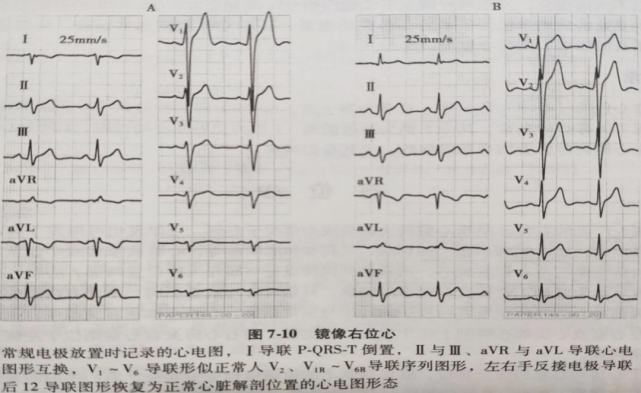 镜像右位心和左右手反接,心电图如何鉴别?