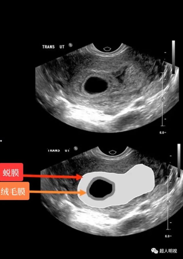 孕5周时,出现双环征,孕囊周围环绕着两个强回声环.