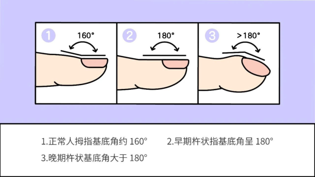 是真的,但没那么简单|肺癌|杵状指|指甲