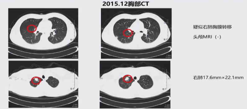 胸膜结节转移成癌求医4年诊疗过程全解析