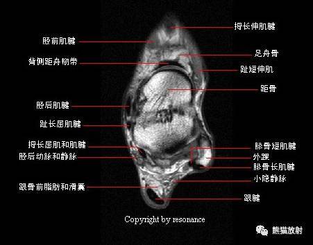 6 趾长屈肌(肌腱),7 中间楔骨,8 拇收肌(横头),9 外侧楔骨,10 蚓状肌