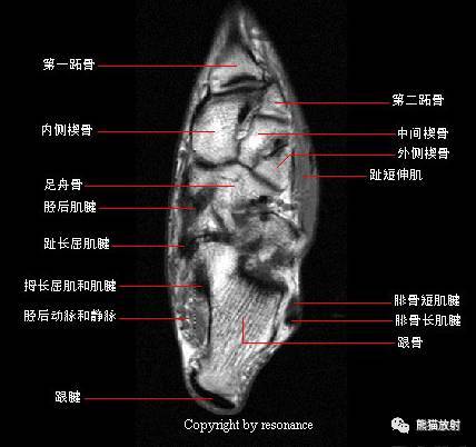 6 趾长屈肌(肌腱),7 中间楔骨,8 拇收肌(横头),9 外侧楔骨,10 蚓状肌