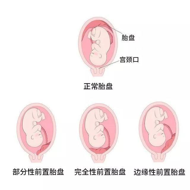 胎盘位置低于胎先露部,附着在子宫下段,下缘覆盖或达到宫颈内口称为