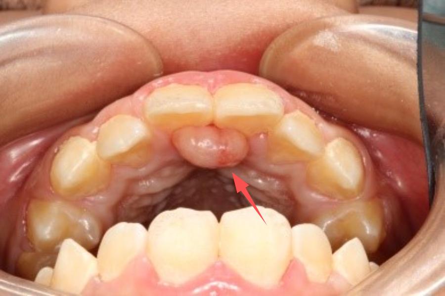 孩子牙龈鼓包除了是马牙还可能是这5种疾病