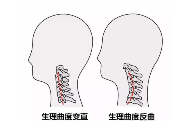 颈椎病,会导致颈椎颈椎生理曲度变直或反弓.