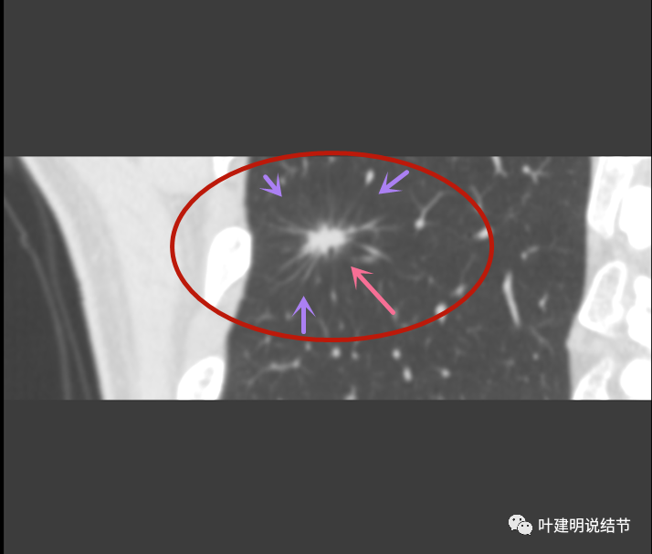 11):混合磨玻璃结节伴毛刺征,血管征一定会是肺癌吗?