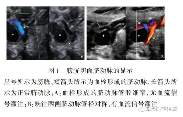 脐动脉血栓形成的产前超声特点分析