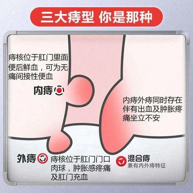 如何判断自己是否得了痔疮?