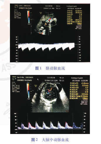 脐动脉,大脑中动脉血流测量:扫查脐动脉及胎儿大脑中动脉,选取近胎盘