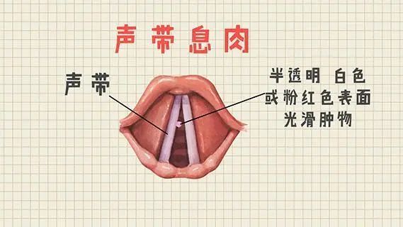 声带息肉危害大及时治疗是关键