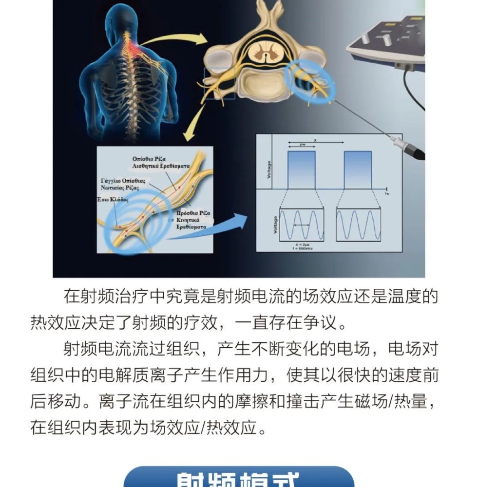 射频治疗技术疼痛科专家共识