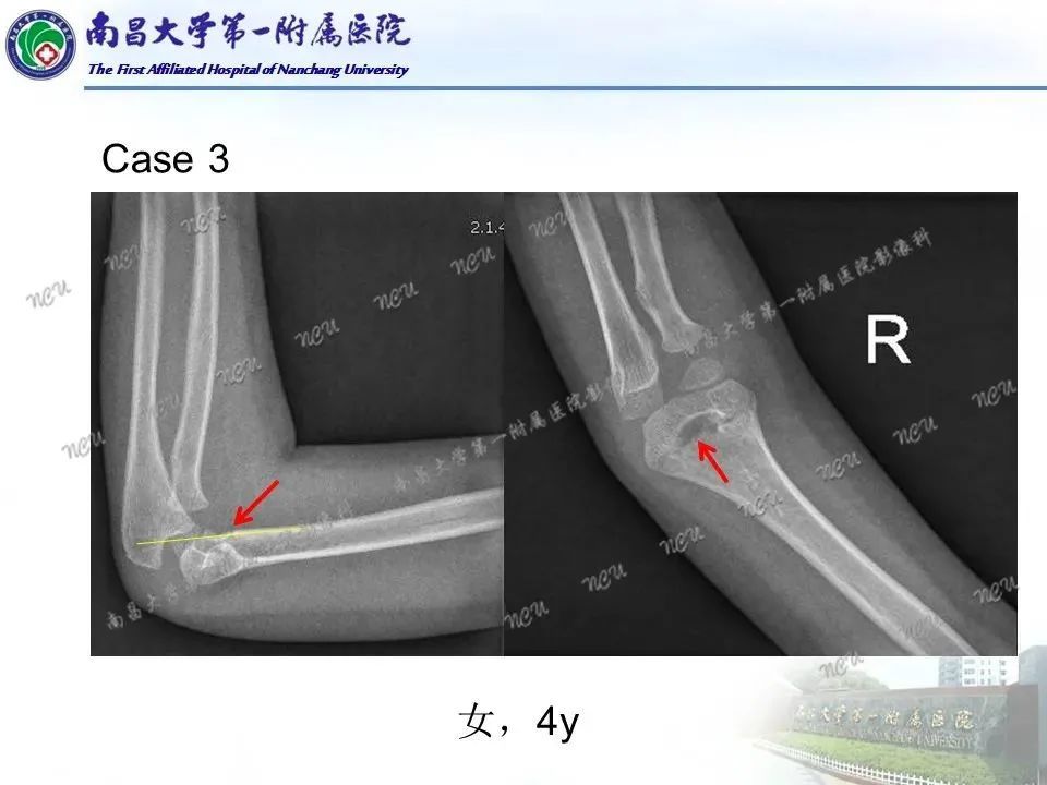 一文掌握 儿童肘关节骨折x线诊断