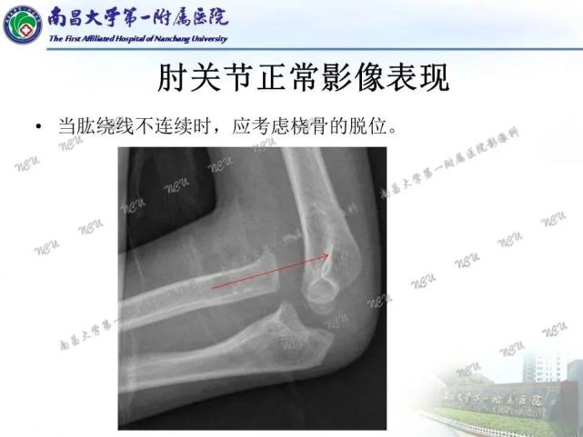 一文掌握|儿童肘关节骨折x线诊断