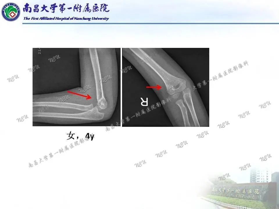 一文掌握儿童肘关节骨折x线诊断