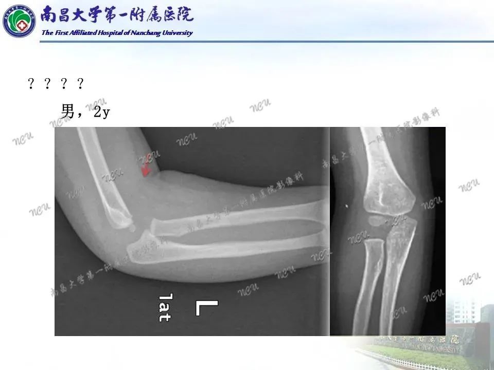 一文掌握儿童肘关节骨折x线诊断