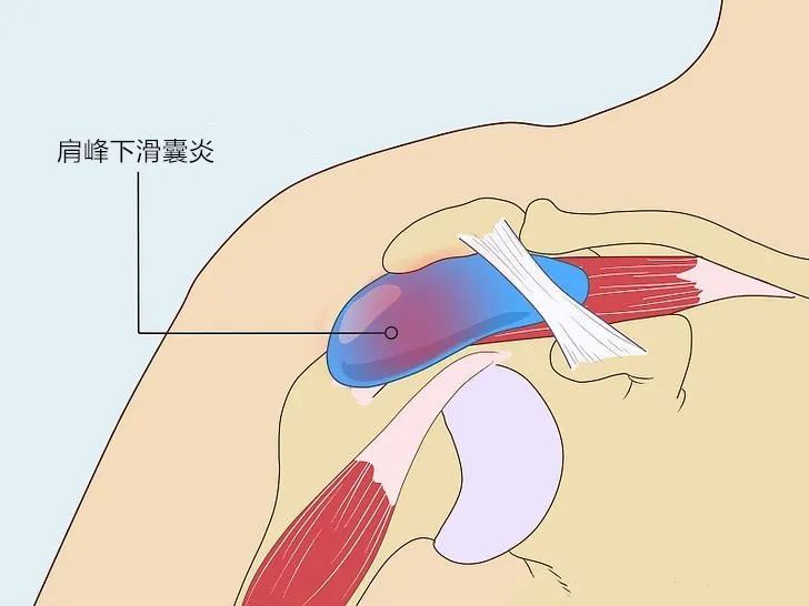 肩峰下滑囊炎通常伴随肩袖肌腱病变或肩峰撞击综合征.