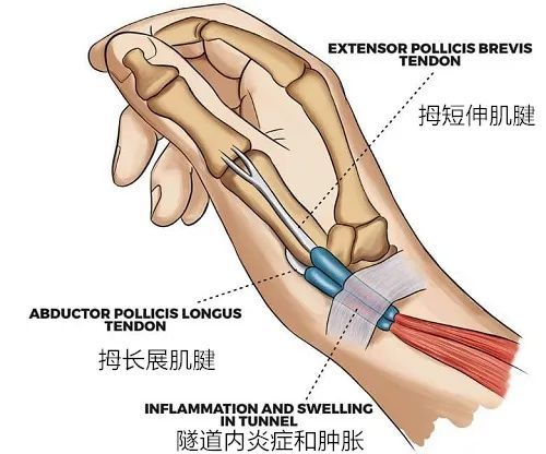 在狭窄的纤维骨管内,拇长外展肌(apl)和拇短伸肌(epb)肌腱的抵抗滑动