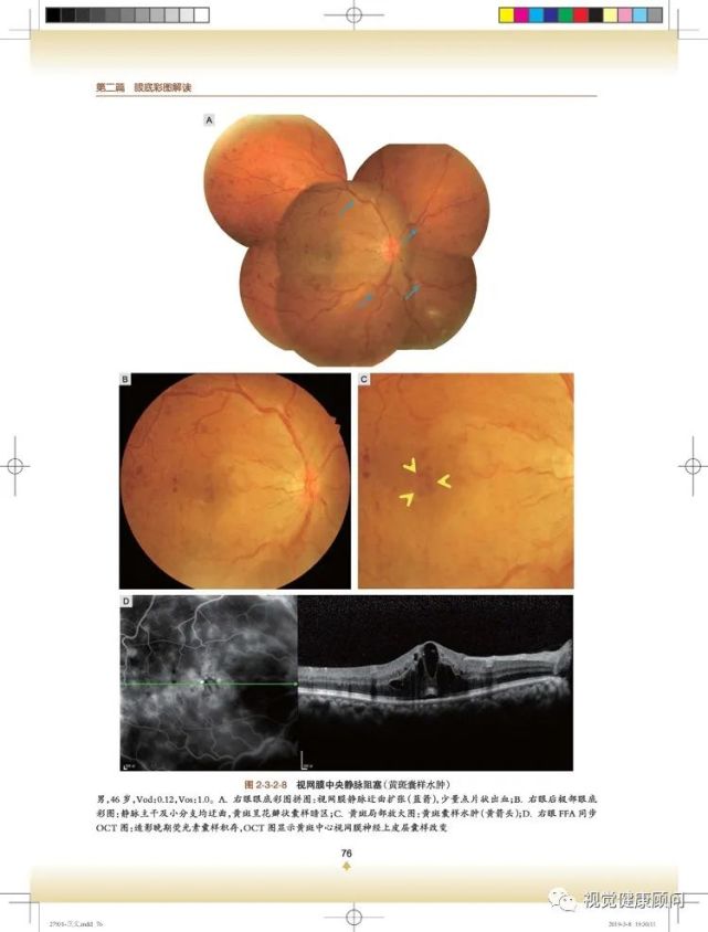 【图片赏析】五种眼底成像下的视网膜脱落